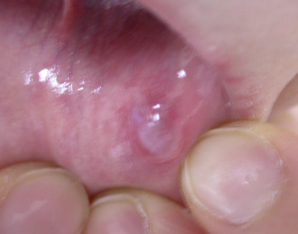 粘液嚢腫